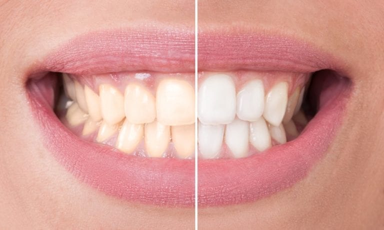 Teeth Whitening Before and After